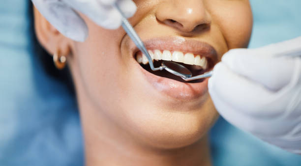 Best Teeth Whitening  in Torrington, WY