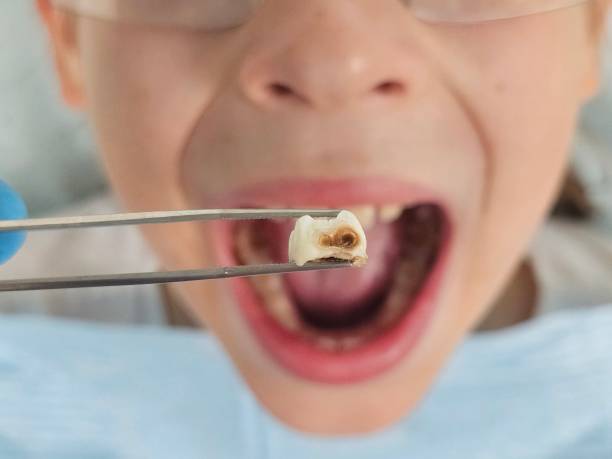 Best Knocked-Out Tooth Emergency  in Torrington, WY